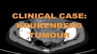 Clinical case  Metastatic cholangiocarcinoma cancer on CT abdomen  How to read and diagnose [upl. by Auahsoj]