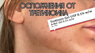 ОСЛОЖНЕНИЯ ОТ ТРЕТИНОИНА Два месяца использования Мой печальный опыт Плюсы и минусы ретиноидов [upl. by Gabby]