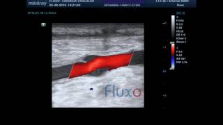 FemoralPosterior Tibial Bypass  Doppler [upl. by Yebot]