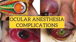 Complications of ocular anesthesia  Diagnosis and management [upl. by Jillie]