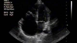 echocardiogramEbstein anomaly apical 4chamber view [upl. by Carolin]