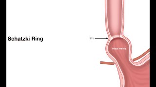 ECELesson 2f5Pathology of EsophagusSchatzki ring [upl. by Harpole]