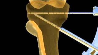 Intervento di osteotomia [upl. by Flanagan]