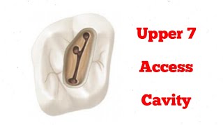 Upper Molars Access Cavity  upper 7 [upl. by Nnylarej]