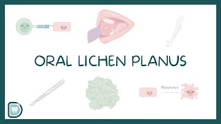 Oral Lichen Planus Causes Diagnosis Types and Management [upl. by Rowena]