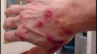 The Morgellons Lesion [upl. by Buehler]