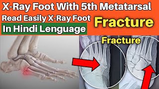 5th metatarsal fracture  Read Easily XRay Foot in hindi [upl. by Jer]