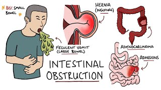 Intestinal Obstruction  Small Bowel Obstruction vs Large Bowel Obstruction [upl. by Pazia716]