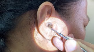 Massive Hard Dry Earwax Removed from Womans Ear [upl. by Tierney358]