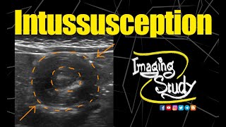 Intussusception  Ultrasound  Case 154 [upl. by Ratcliff916]