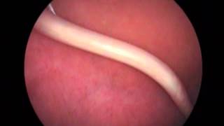 round worm in the stomach and duodenum with gastric polyp [upl. by Ordnassela]