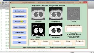 Matlab Project on Lung Nodule Detection using neural network Image Processing Project [upl. by Bergh]