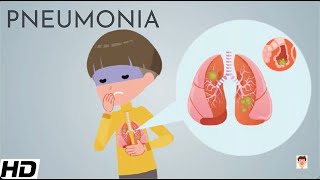 Pneumonia Everything You Need To Know [upl. by Ary545]