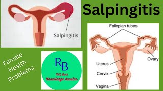 RB MCQ Bank Knowledge BoosterSalpingitis Female Health Problem [upl. by Anafetse721]