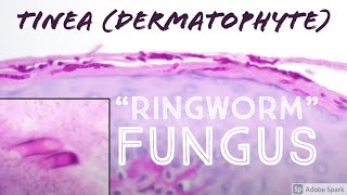 quotRingwormquot under microscope Fungus Skin Infection TineaDermatophyte 5Minute Pathology Pearls [upl. by Gladine115]