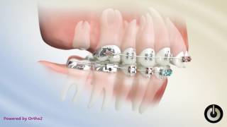 Correcting Overjet by Extracting Upper 2nd Molars [upl. by Aicella]