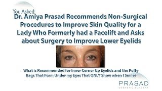 How Under Eye Wrinkles That Appear When Smiling can be Helped with NonSurgical Treatment [upl. by Dellora546]