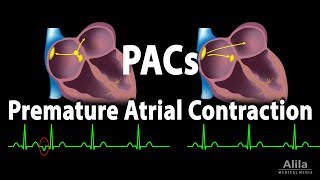 Premature Atrial Contractions PACs Animation [upl. by Aihtnyc885]