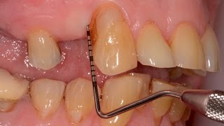 Periodontal Gum Disease Treated with Guided Tissue Regeneration Upper Canine [upl. by Tildy]