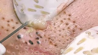 NEW Pimple Popping Compilation  Blackheads removal  Pimple removal vids of 2021 [upl. by Audrit]