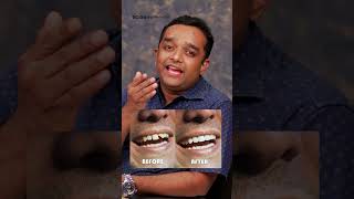 അര മണിക്കൂറിൽ പല്ല് ശെരിയാക്കാം dentalclinic dentaltips dentalcrowns dentalveneers smile [upl. by Imij]