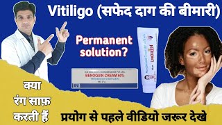 Vitiligo Parmanent treatment  Monobenzone cream for skin lightening [upl. by Kilmarx]