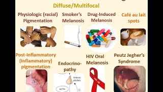 7 HIVmelanosis amp Peutz jeghers syndrome [upl. by Atteugram]