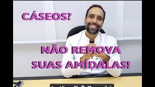 Você tem CÁSEOS Não REMOVA suas AMÍDALAS [upl. by Terraj]