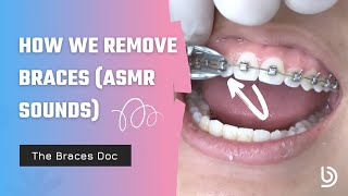 Satisfying Braces Removal w The Braces Doc ASMR — How we remove braces [upl. by Anma]