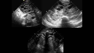 Chest FRCR2b CASES [upl. by Sabino606]