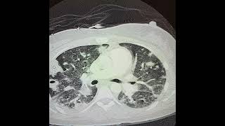 CT Scan of septic emboli [upl. by Eltsirhc]