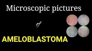 Microscopic histology of ameloblastoma microscopic pictures of oral pathology Dr Poojireddy [upl. by Elocin481]