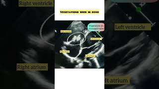 Tricuspid valve vegetation  infective endocarditis heartvalve cardiology echo [upl. by Arrakat462]