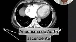 Aneurisma de Aorta ascendente  Angiotomografia de aorta em detalhes [upl. by Yoj]