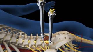 Lumbar Fusion of L5 S1 Animation [upl. by Eob]