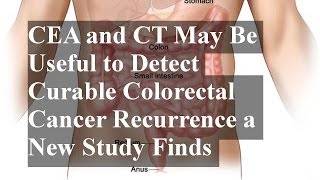 CEA and CT May Be Useful to Detect Curable Colorectal Cancer Recurrence a New Study Finds [upl. by Juliana]