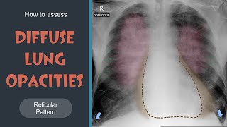 How to assess Diffuse Lung Opacities  Reticular pattern  Lec 13 [upl. by Hannan20]