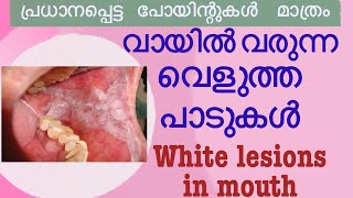 വായിൽ വെള്ള പാട് വരാനുള്ള കാരണങ്ങൾ white lesions in mouth [upl. by Aicirtan2]