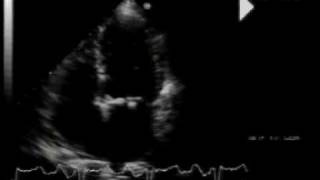 calcific aortic stenosismitral annular calcification and flail mitral valve 22 [upl. by Dyana390]