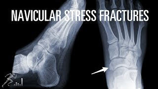 How can you quickly recover from a navicular stress fracture [upl. by Aziram]