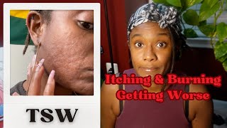 Is your ECZEMA getting WORSE  topicalsteroidwithdrawal [upl. by Ztnaj453]