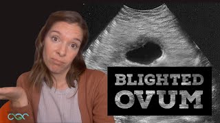 What is a blighted ovum anembryonic pregnancy Explained by a genetic counselor [upl. by Oneida798]