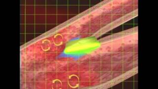 Whole Blood Viscosity Links to Cardiovascular Disease [upl. by Adnavoj129]