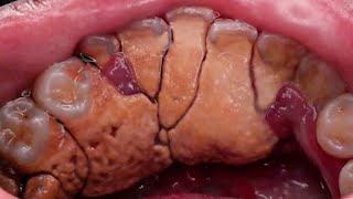 Tartar Removal by Dentist  removing tartar from teeth [upl. by Blackington979]