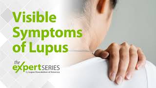 The Expert Series S6E2 Visible Symptoms of Lupus [upl. by Sharlene939]