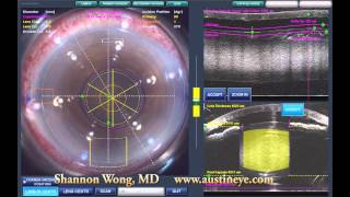 Lensx laser cataract surgery  brunescent cataract 101512 [upl. by Obau70]