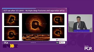 Cracking the calcium code  Novelty and utility of Hertz Contact intravascular lithotripsy  EuroPCR [upl. by Atthia698]