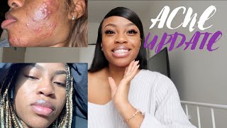 SKINCARE SATURDAYS  HOW I CLEARED 6 YEARS OF ACNE IN 3 MONTHS  FT MDacne [upl. by Ama]