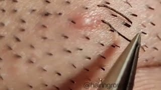 blackheads lipsl Acne treatment l Extraction cysts and blackheads Hair l blackheads lips [upl. by Darius997]