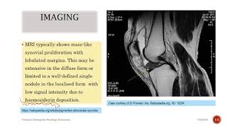 Pigmented Villonodular Synovitis [upl. by Htez]
